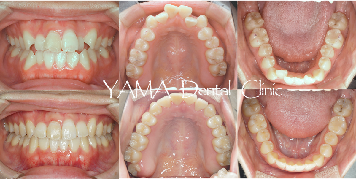 invisalign矯正終了後比較写真